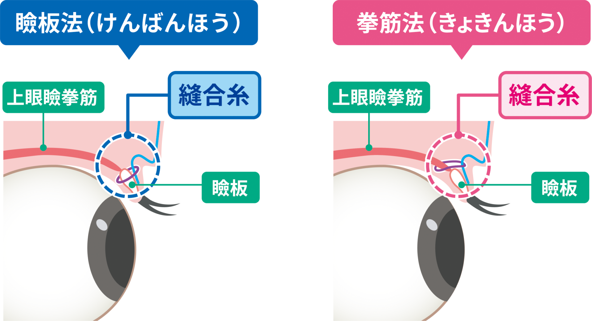 二重埋没の瞼板法と挙筋法