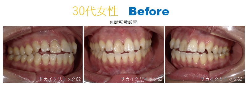 30代女性の歯列矯正の症例写真