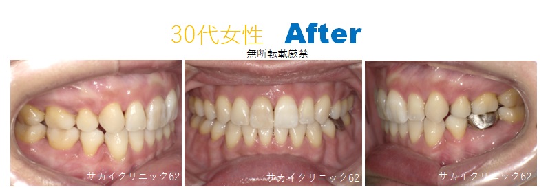 30代女性の歯列矯正の症例写真