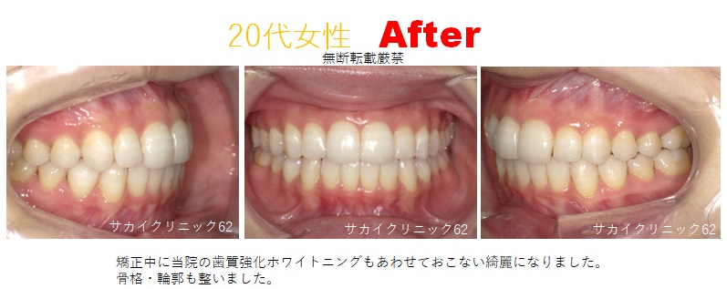 20代女性の歯列矯正の症例写真