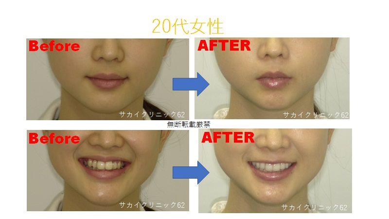 20代女性の歯列矯正の症例写真