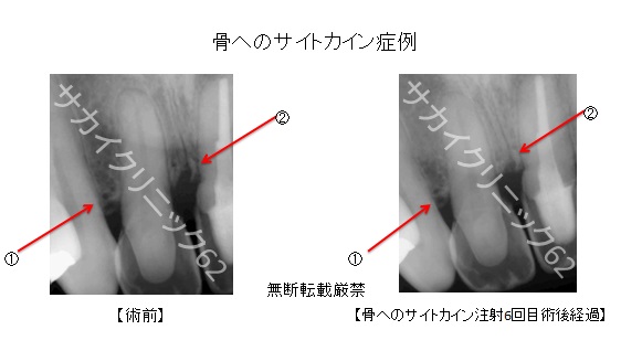 骨へのサイトカイン注射の症例写真