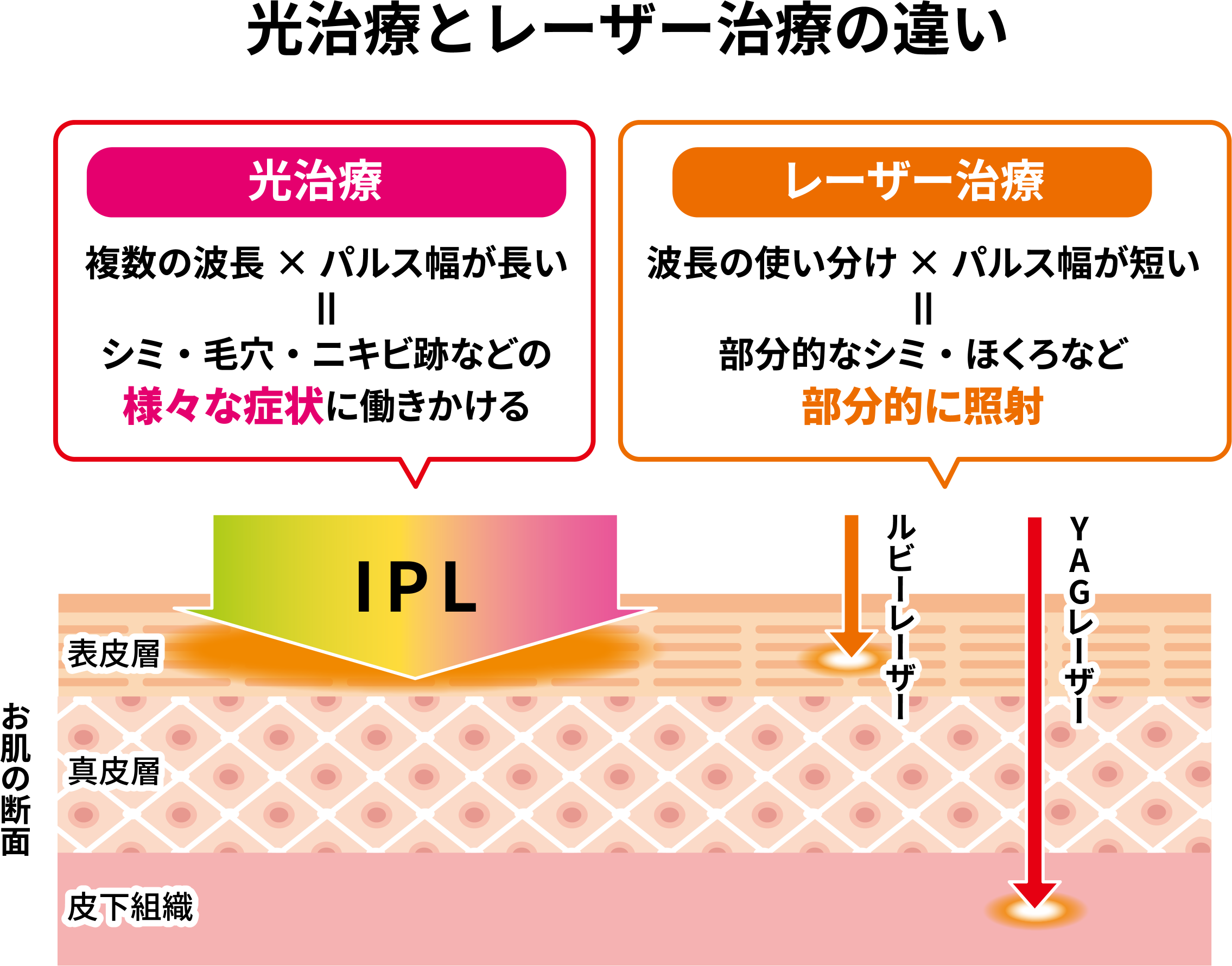 光治療とレーザー治療の違い