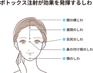 ボトックス注射が効果を発揮するシワ