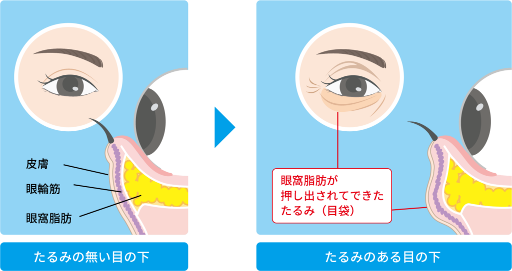 正常な目の下とたるみのある目の下の説明図