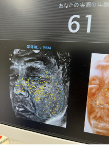 紫外線シミの診断画像