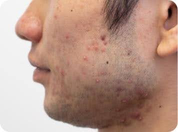ニキビ跡治療の左頬のビフォー画像