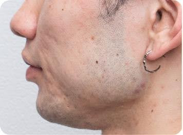 ニキビ跡治療の右頬のアフター画像