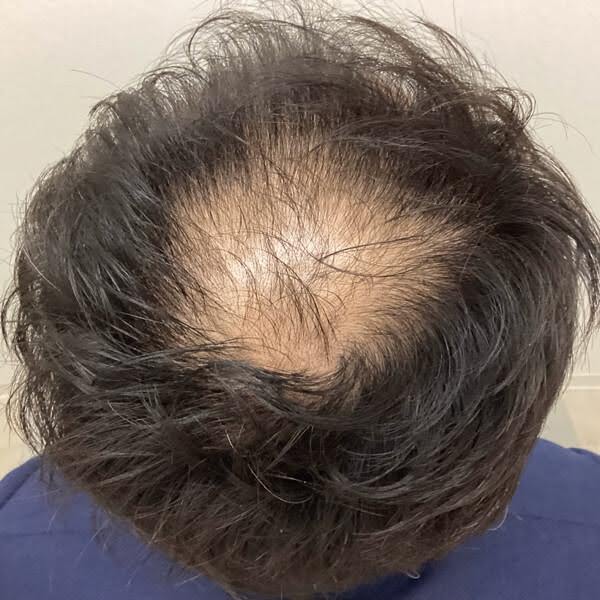 男性の治療前の頭頂部の写真