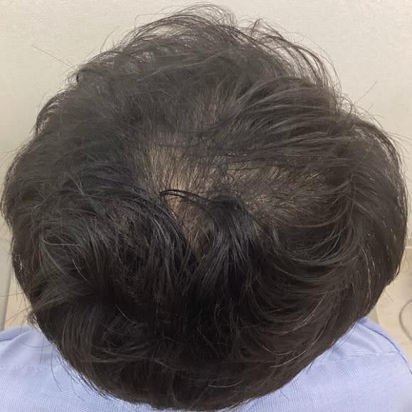 男性の治療後の頭頂部の写真