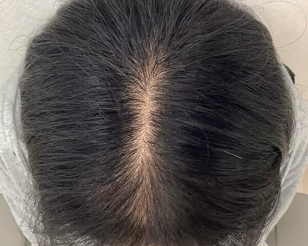 女性の治療後の頭頂部の写真