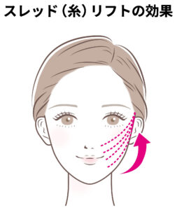 糸リフトの効果