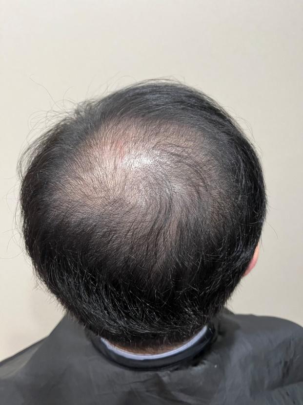 林先生のAGA治療前の頭皮