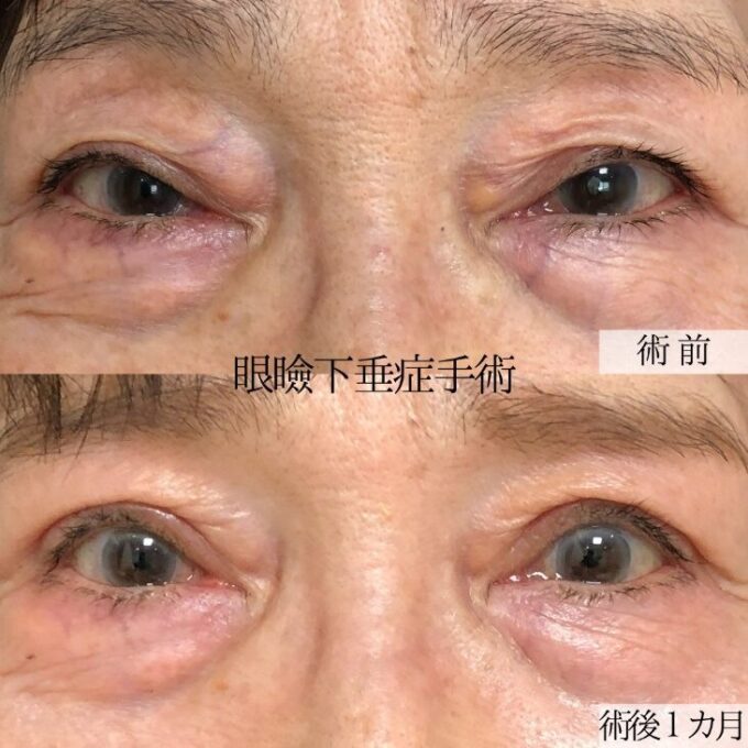 眼瞼下垂の施術を受けた女性のビフォーアフター