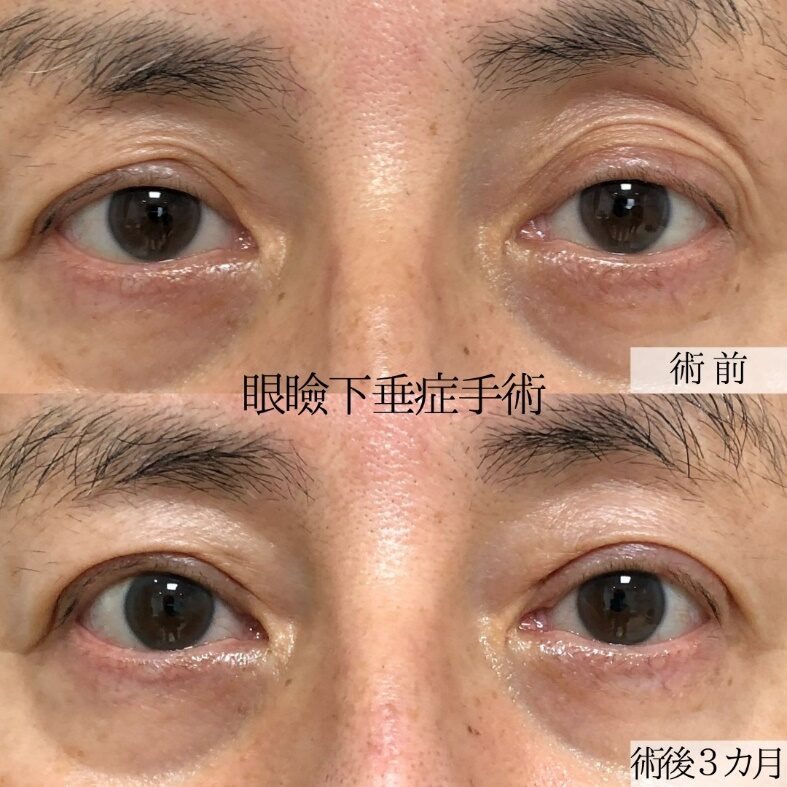 眼瞼下垂の施術を受けた男性のビフォーアフター