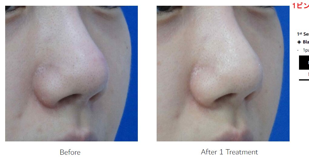 鼻の毛穴の黒ずみとニキビの症例のビフォーアフター