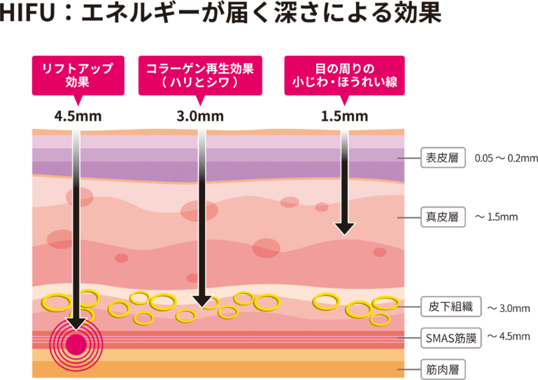 ハイフの到達深度と効果