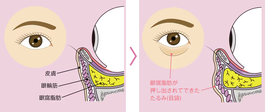  たるみのない目の下とたるみのある目の下