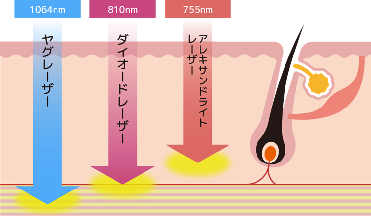 脱毛レーザーの到達深度