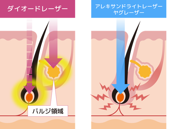 レーザーによるターゲット組織の違い