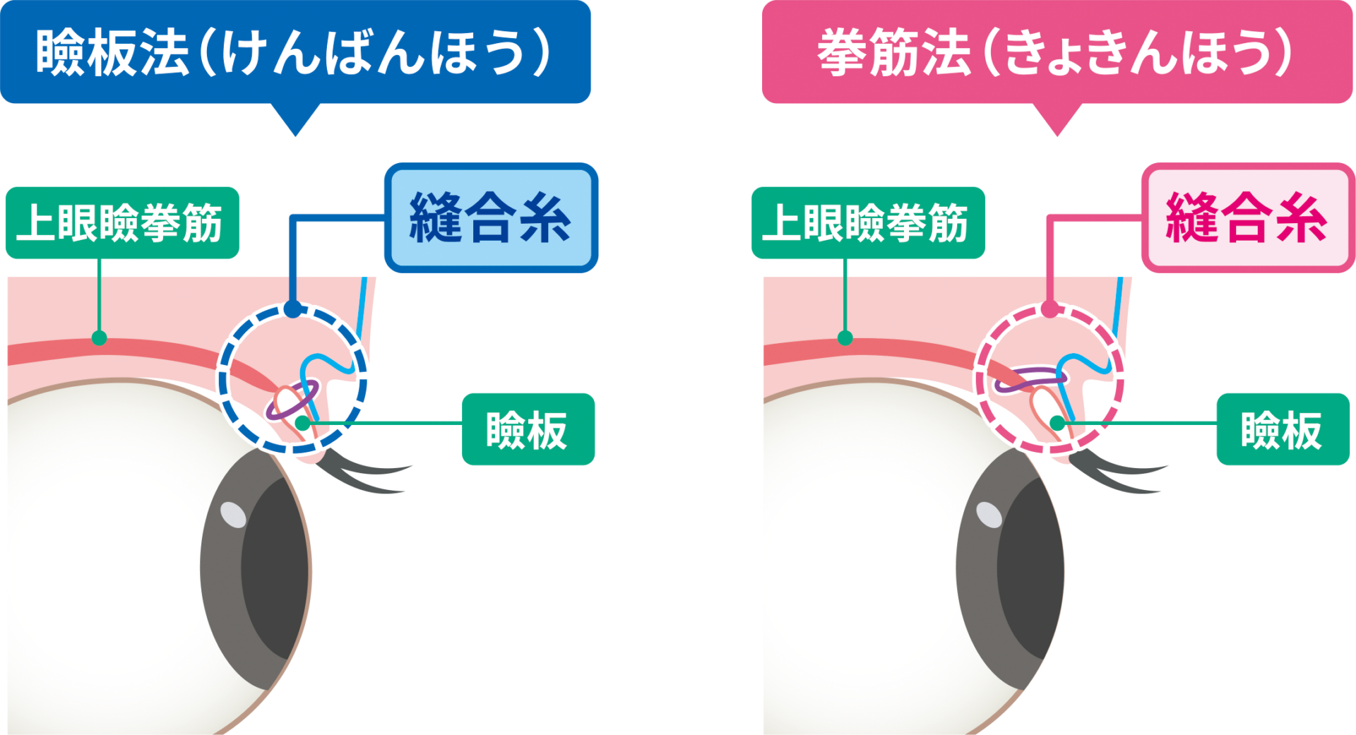 瞼板法と挙筋法の違い