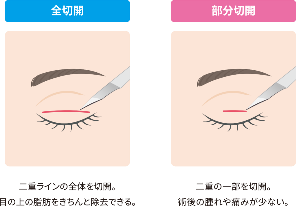 切開法の種類