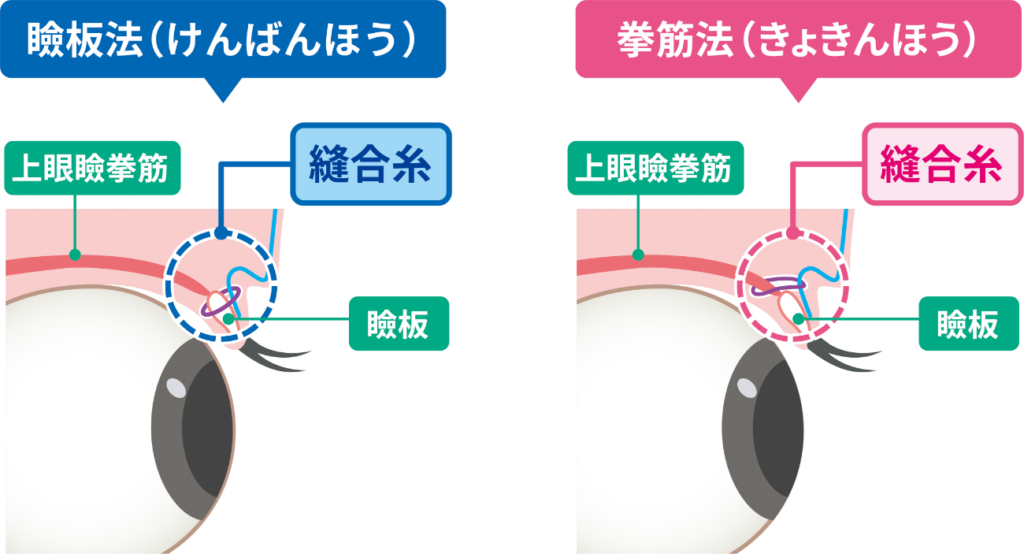 瞼板法と挙筋法