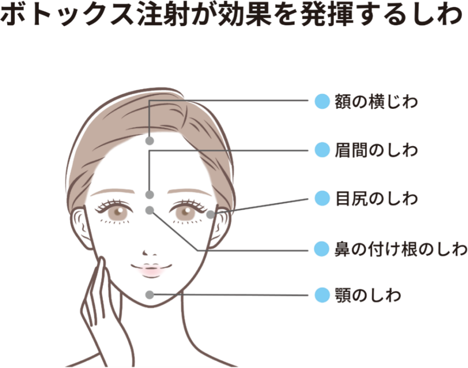 ボトックスが効果を発揮するしわ