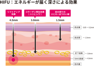 ハイフのエネルギーが届く深さによる効果