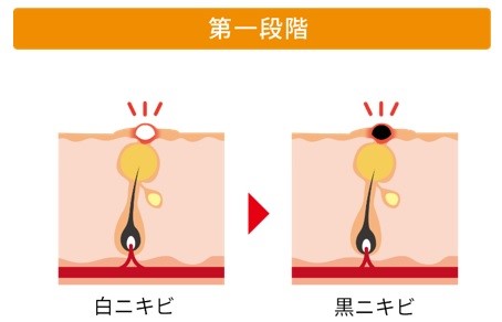 ニキビの第一段階