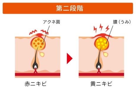 ニキビの第二段階