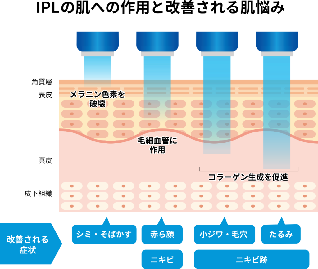 IPLの肌への作用と改善される肌悩みのイラスト