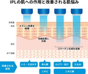 IPLの肌への作用と改善される肌悩みのイラスト