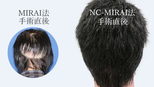 親和クリニックの自毛植毛の施術写真