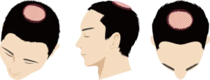 頭頂部がO型に脱毛してきた状態
