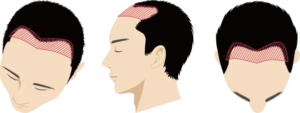 生え際から進行した状態