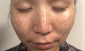 ルメッカ1回目直後