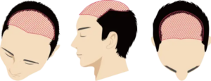 全体的にかなり進行している状態