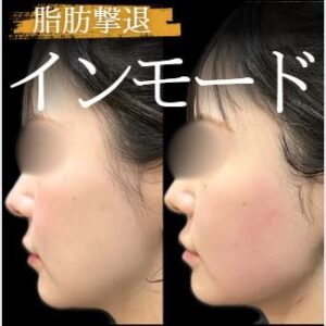ルラ美容クリニックのインモードVリフティングの症例