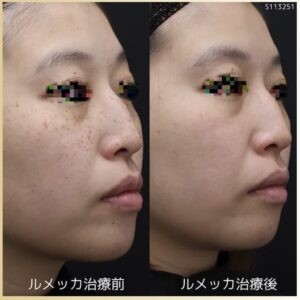 シェリークリニックのルメッカの症例
