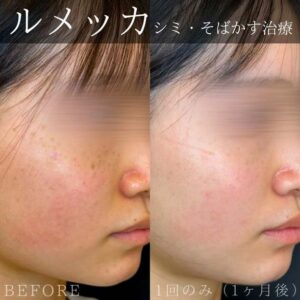 ルラ美容クリニックのルメッカの症例