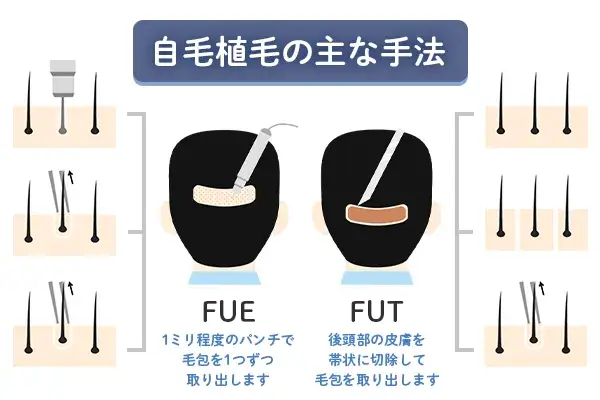 自毛植毛の代表的な術式のFUT法とFUE法について分かる画像