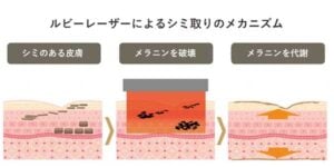 ルビーレーザーによるシミ取りのメカニズムのイラスト