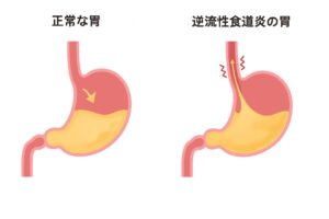 正常な胃と逆流性食道炎
