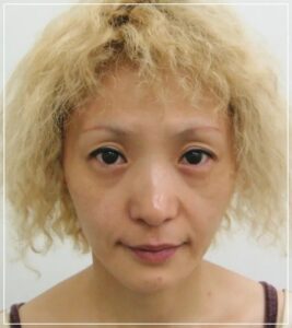 手術前の患者
