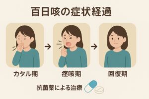 大人の百日咳の経過