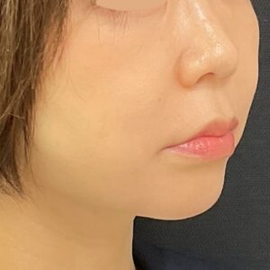 ボルニューマ＋ハイフ（右・施術後）