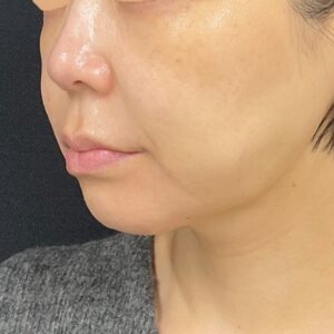 ボルニューマ＋ハイフ（左・施術前）