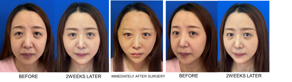 30代の女性のクイックチタンペックリフトのビフォーアフター2 
