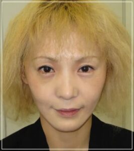 手術2～3週間後の患者